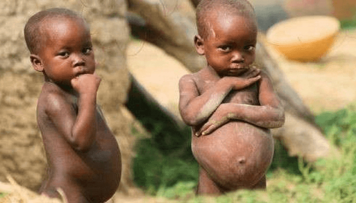 malnutrition-1